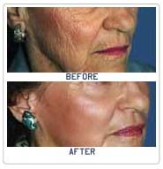 Laser Skin Resurfacing, Plastic Cosmetic Surgery Surgeon, Cutaneous Laser Resurfacing